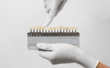 Вініри керамічні, фото 1