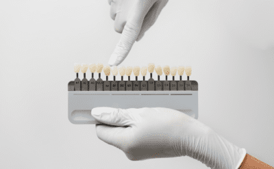 Вініри керамічні, фото 2